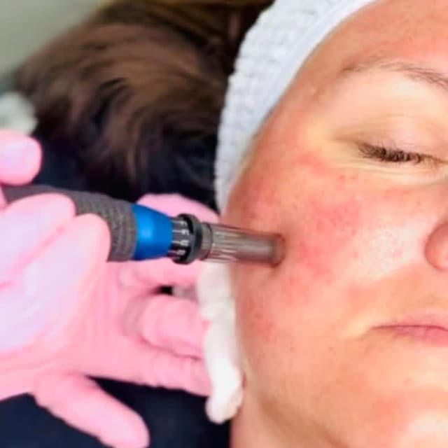 Microneedling Package at Magnolia Maiden Salon & Aesthetics in Elkins, AR