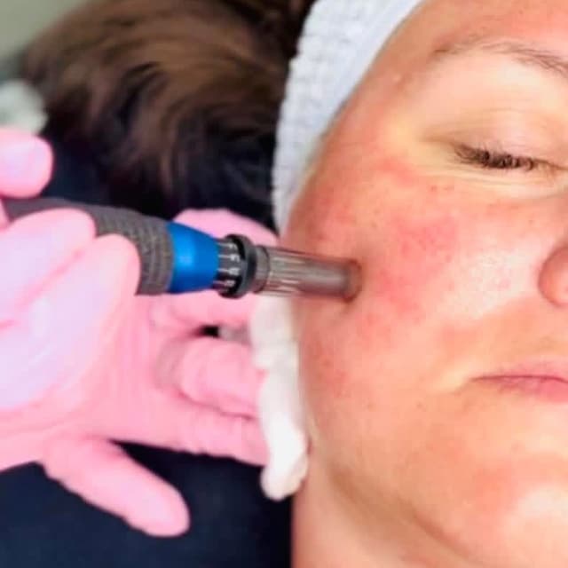 Vampire Facial Package at Magnolia Maiden Salon & Aesthetics in Elkins, AR